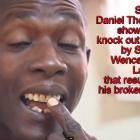 Daniel Theodore showing teeth broken by Wencesclass Lambert
