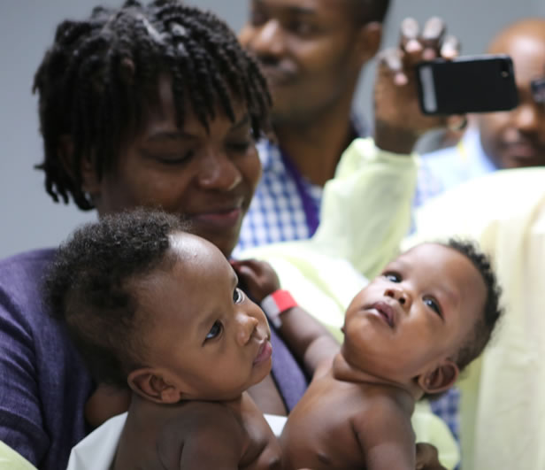 Medical first in Haiti, Conjoined twin separation
