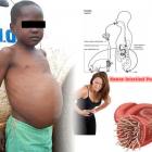 Some 25% of Haitian children suffer from intestinal parasites