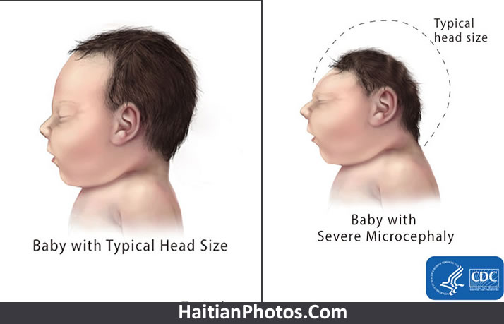 What is Microcephaly in a new born baby?