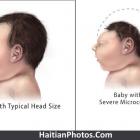 What is Microcephaly in a new born baby?